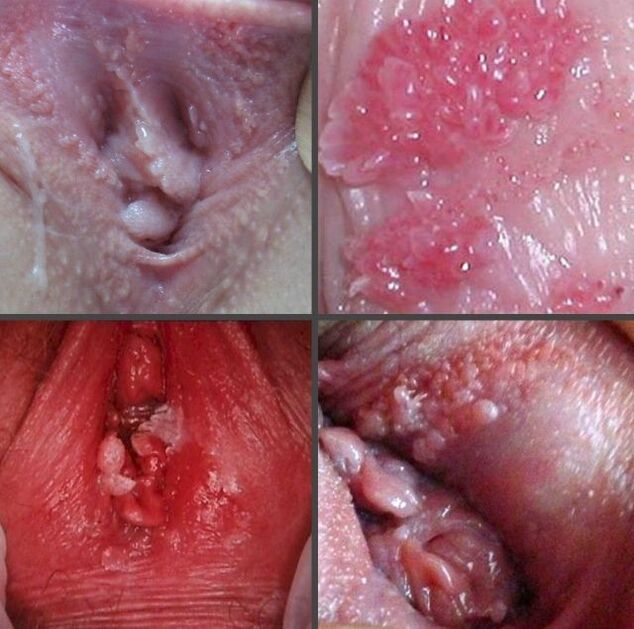 Izbliza papiloma u vagini