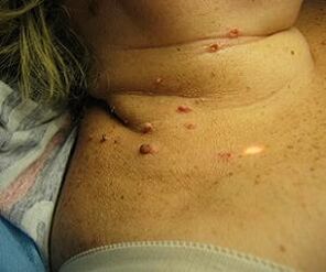 humani papiloma virus na vratu