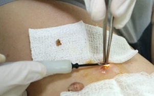 hirurško liječenje humanog papiloma virusa