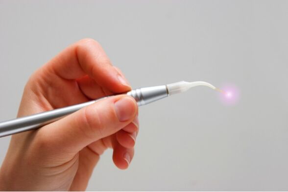 laser za uklanjanje papiloma