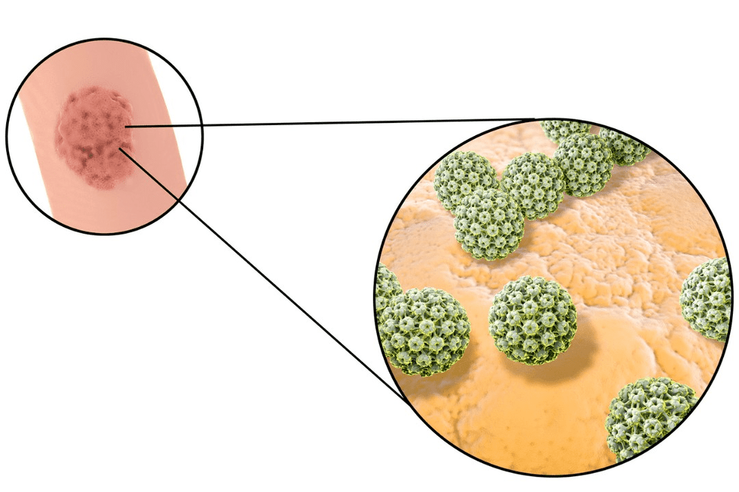 izvor infekcije papilomom skvamoznih ćelija