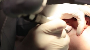 Lasersko uklanjanje papiloma na kapku